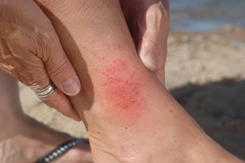 Jellyfish, weever fish, wasps and mosquitoes: what to do when summer bites back